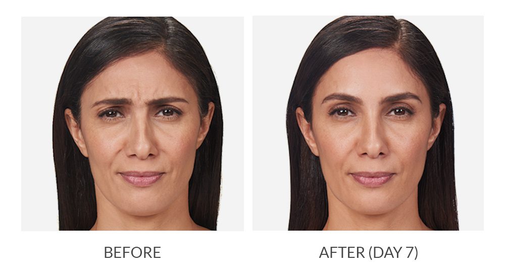 glutathione injections queen creek Aesthetic | Botox & Fillers Best IV Therapy in Queen
